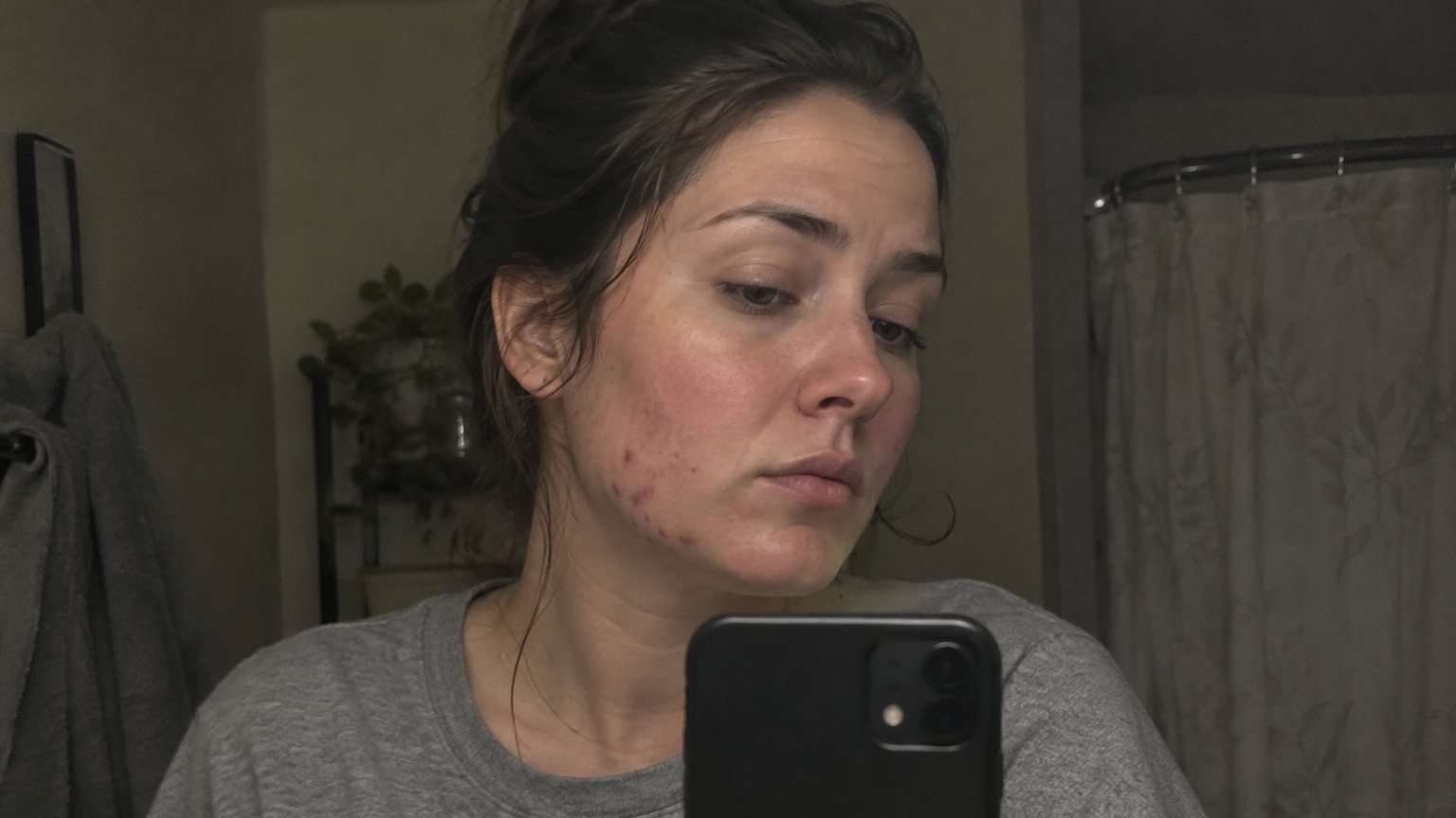 An adult woman studies a phone selfie in a dim bathroom mirror, with ordinary jawline breakouts visible.